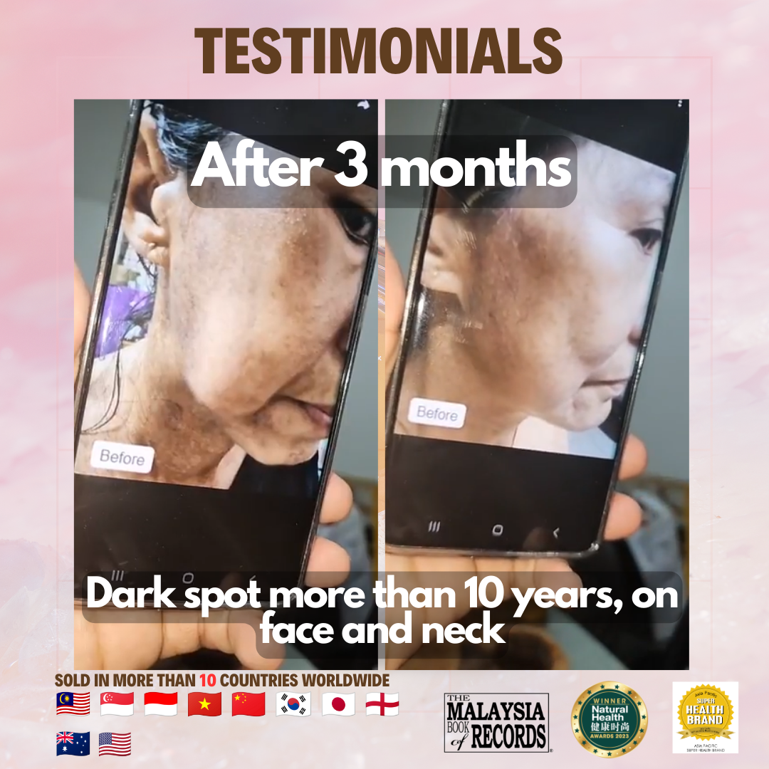 Dark spots more than 10 years, face and neck