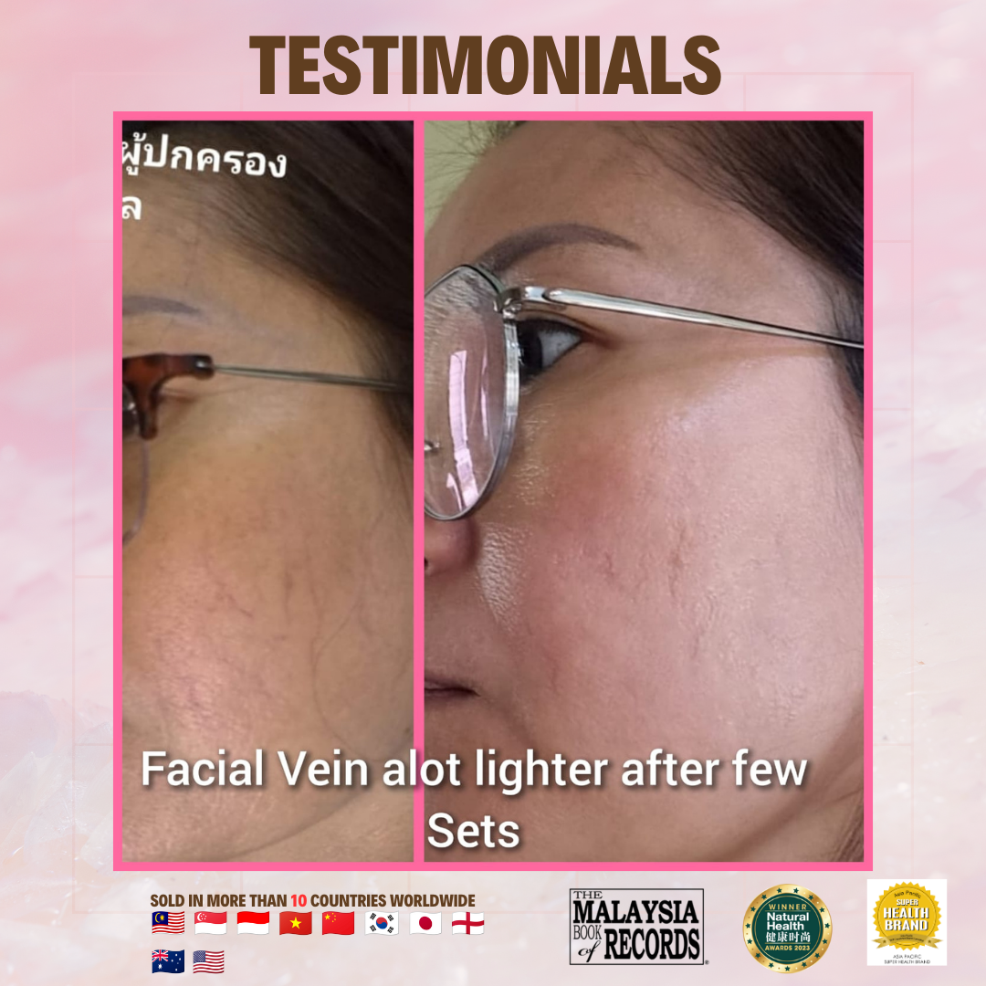 Facial Vein gets better